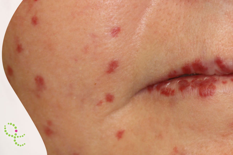 Telangiectasia hemorrágica hereditária (THH)
