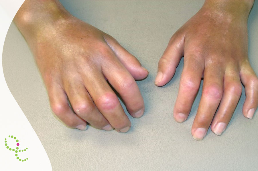 Esclerodermia sistêmica