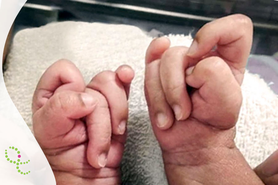 Síndrome de Edwards