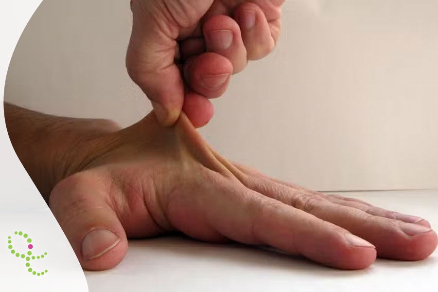 Síndrome de Ehlers-Danlos (SED)